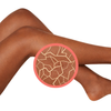 dry and dehydraded skin