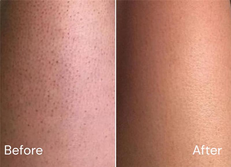 Before and after skincare result