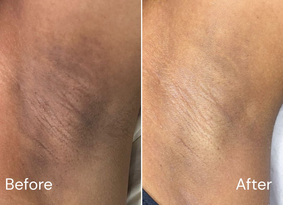 Before and after skincare result