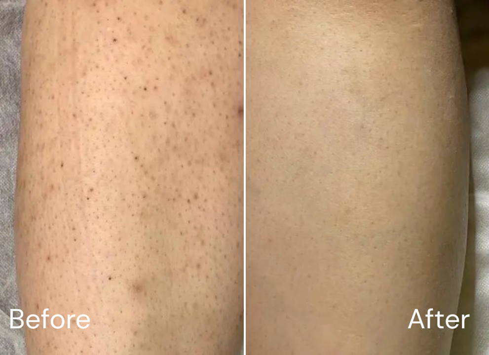 Before and after skincare result