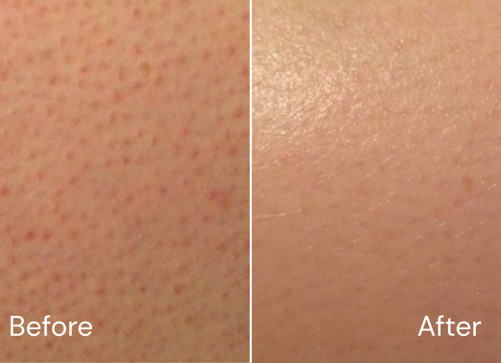 Before and after skincare result