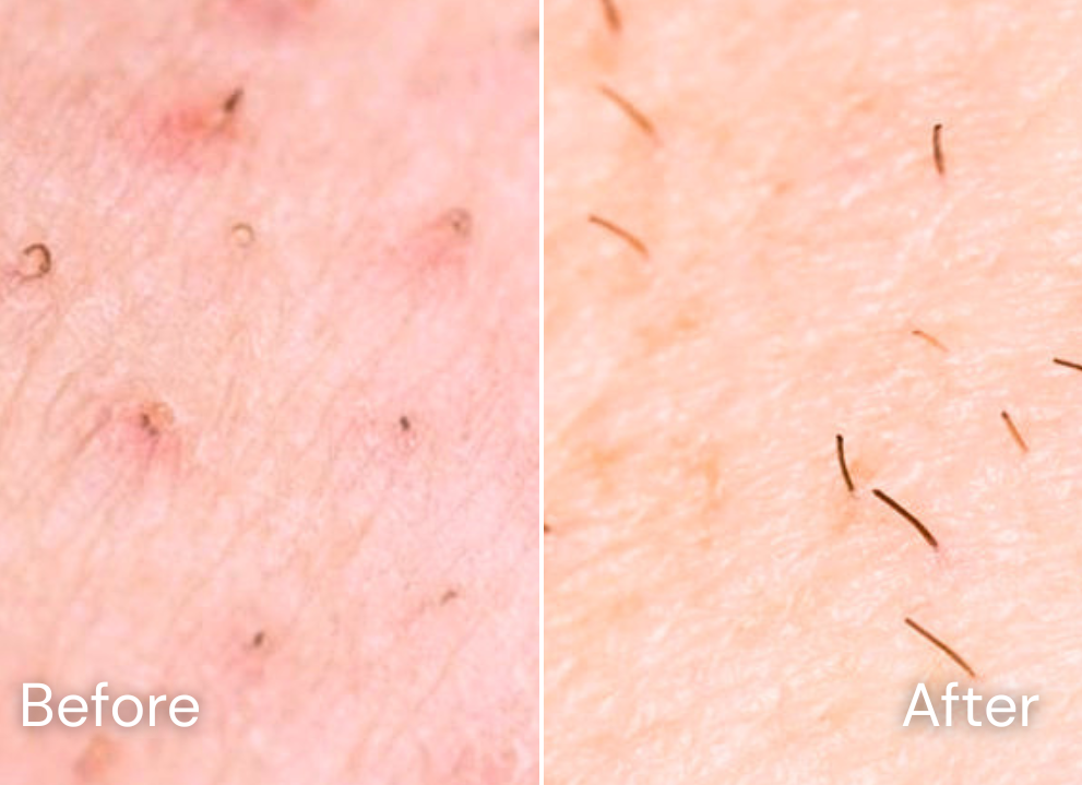 Before and after skincare result