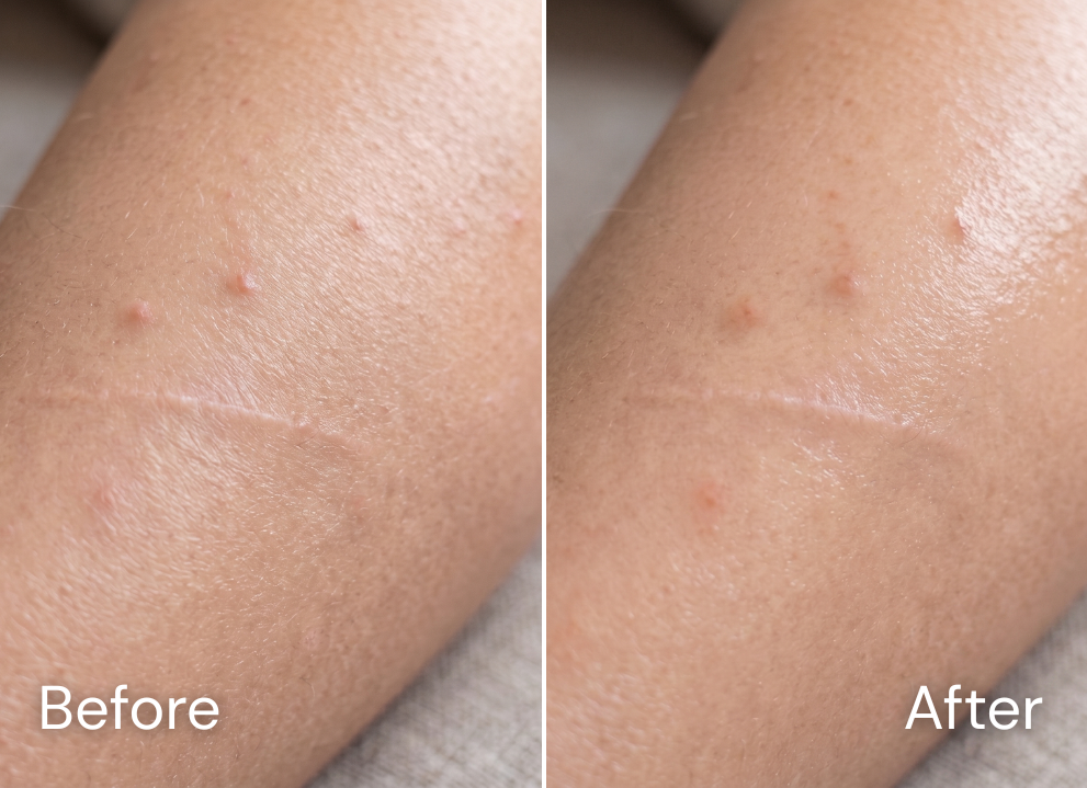 Before and after skincare result